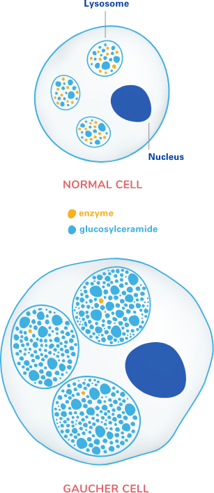 healthy cell versus a Gaucher cell